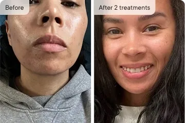 Camila R. before and after Ouraskin treatment
